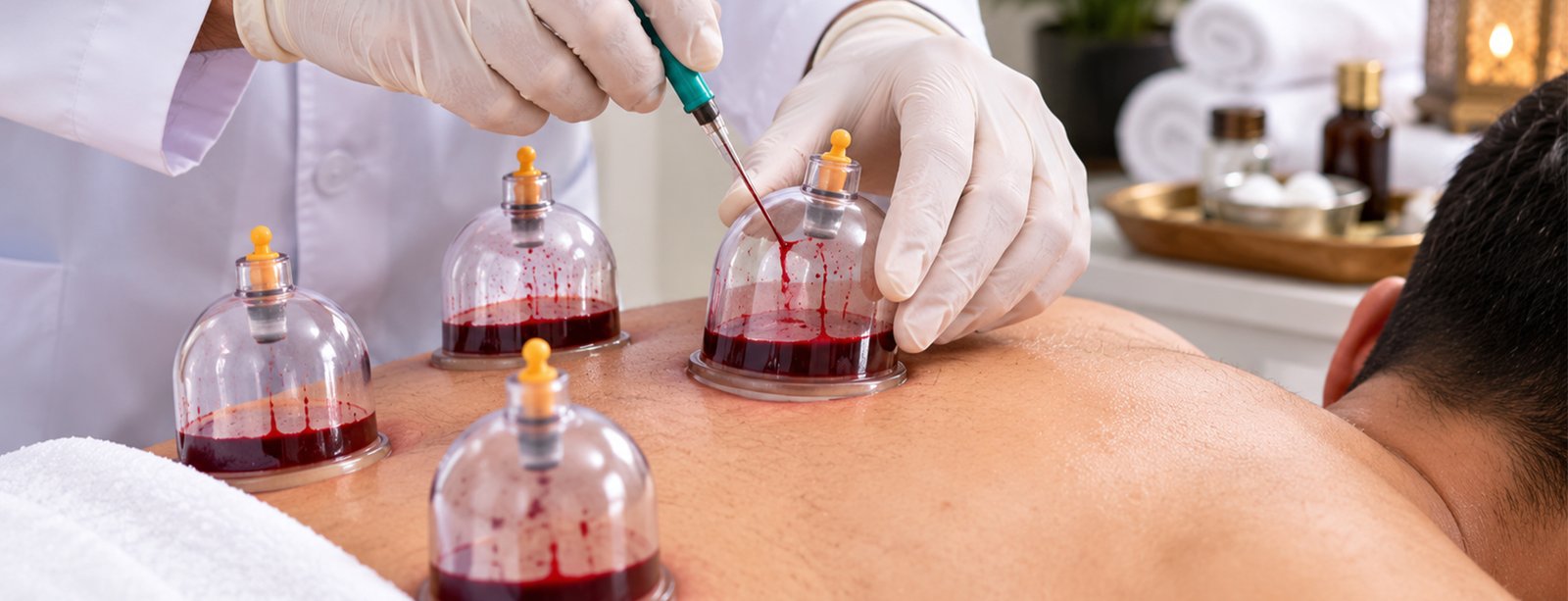 Hijama الحجامة